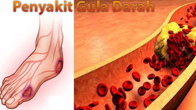 Informasi Penyakit Gula Darah