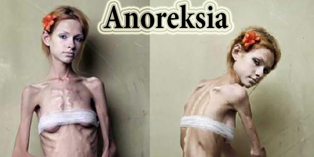 Penyakit Anoreksia Yang Harus Anda Waspadai !