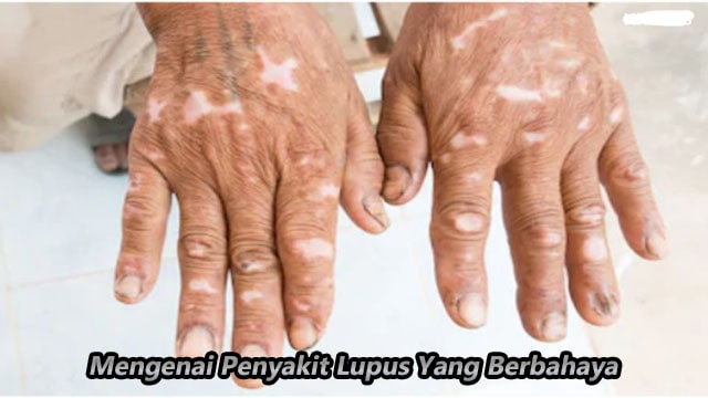 Mengenai Penyakit Lupus Yang Berbahaya