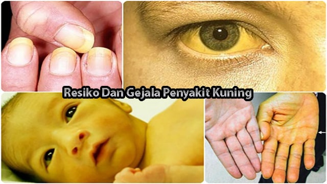 Resiko Dan Gejala Penyakit Kuning